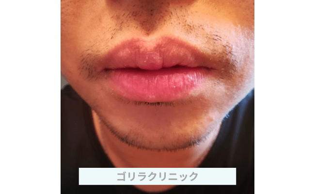 golir15