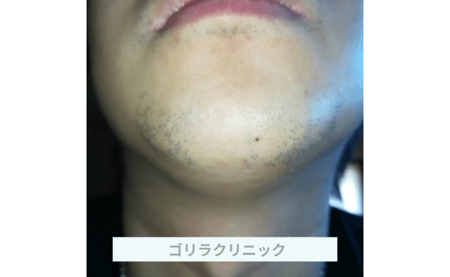 golira4